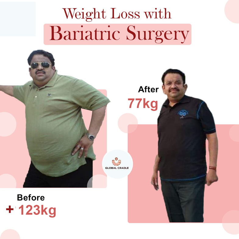 Bariatric Surgry Before After Dr. Nitin Bansal
