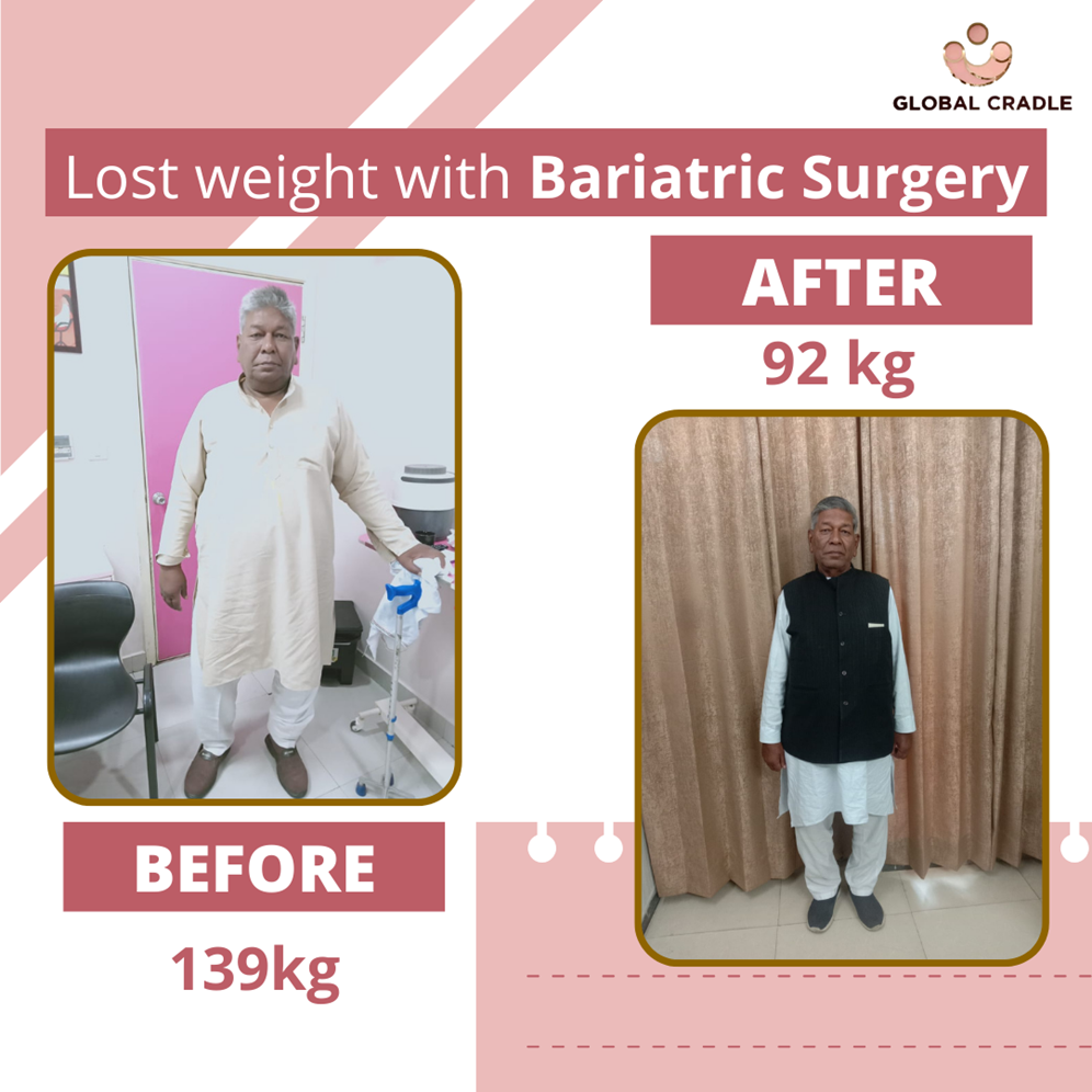 Bariatric Surgry Before After Dr. Nitin Bansal